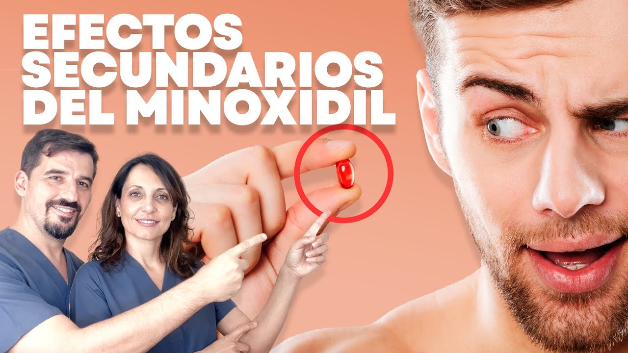 🔵 Minoxidil en pastillas y Minoxidil tópico: 😵 Efectos secundarios.