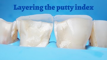 Putty index technique - How to layer composite over it?
