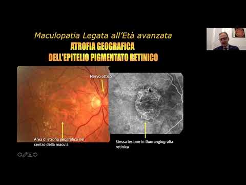 Video: I Geni Della Degenerazione Maculare Legati All'età Mostrano Associazione Con Il Cheratocono?