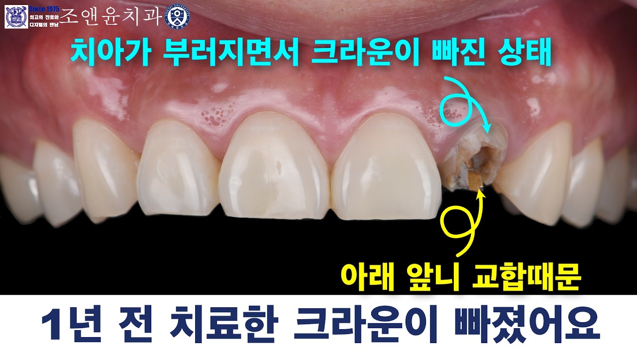 [내일남] 앞니 크라운이 빠졌어요 : 앞니교합은 심미보철치료 (라미네이트, 앞니 지르코니아 크라운) 를 돌출되어 보이도록, 탈락되도록 할 수 있으며 교합문제도 발생시킬 수 있습니다