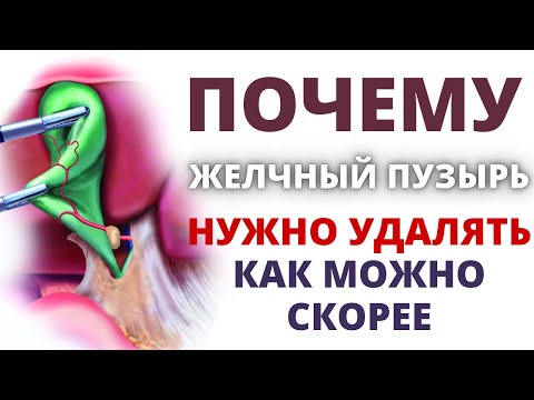 Почему нужно удалять желчный пузырь как можно скорее! Нашли камень в желчном пузыре что делать?