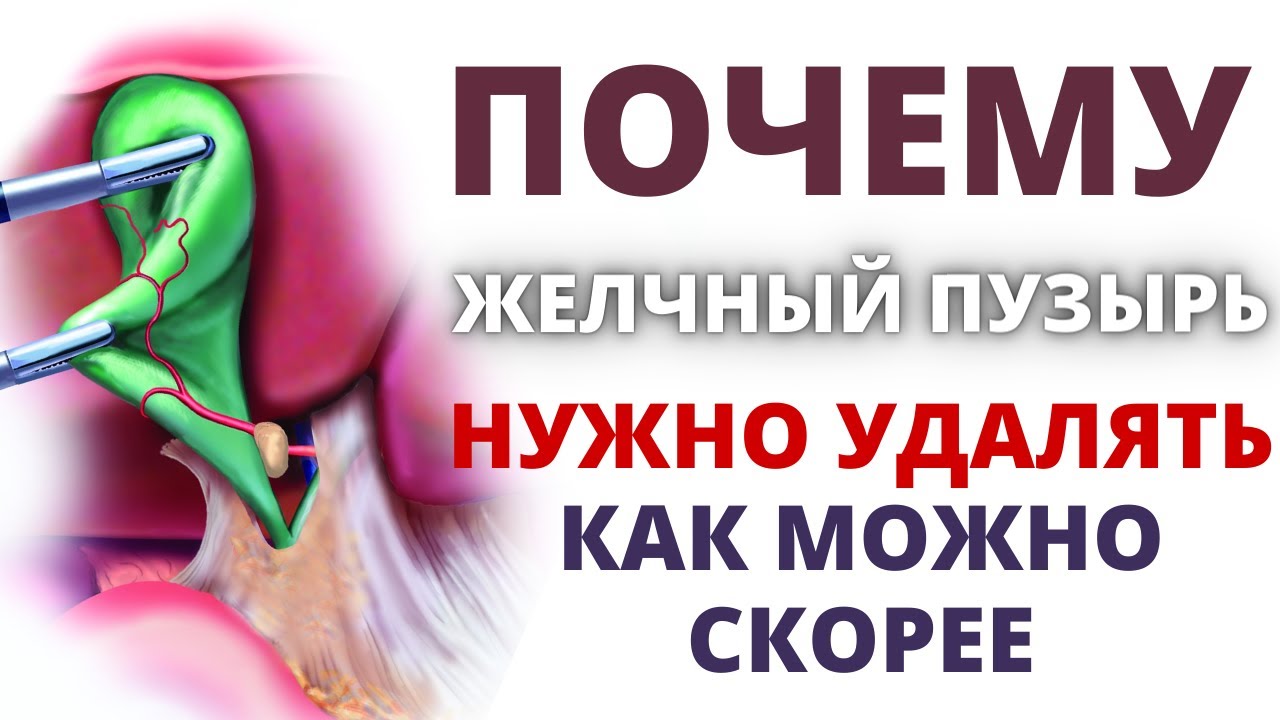 Почему нужно удалять желчный пузырь как можно скорее! Нашли камень в ...