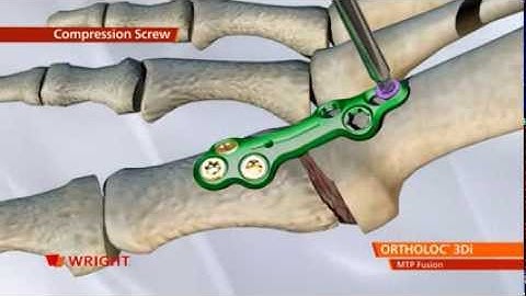ORTHOLOC™ 3Di Foot Reconstruction System MTP Fusion Plate Animation