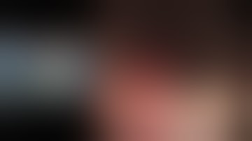 Case 9_Endoscopic full thickness resection of gastric GIST