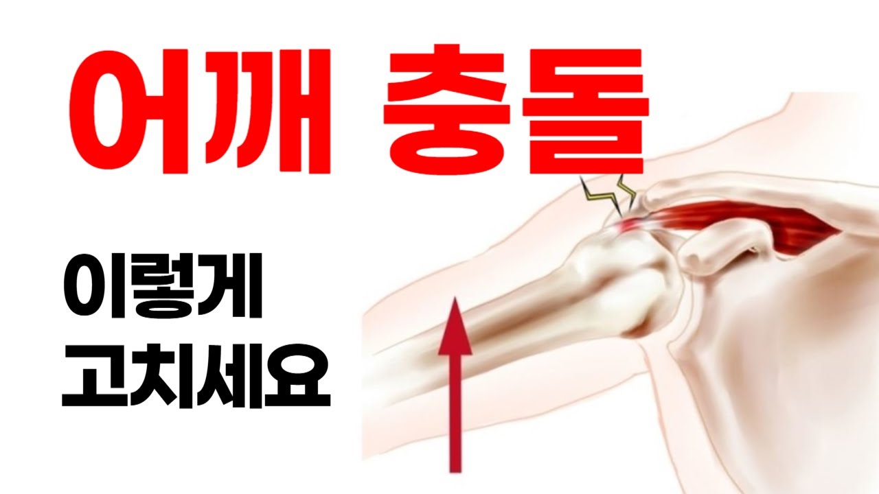 [충돌 증후군, 어깨 찝힘 재활] 회전근개 운동 하지마세요 제발 (상방회전 운동)