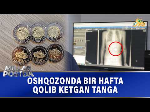 Oshqozonda bir hafta qolib ketgan tanga "MILLAR POSTDA"