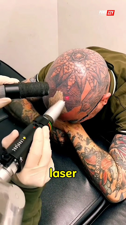 Where Does Tattoo Ink Go After Laser Removal‼️🥲