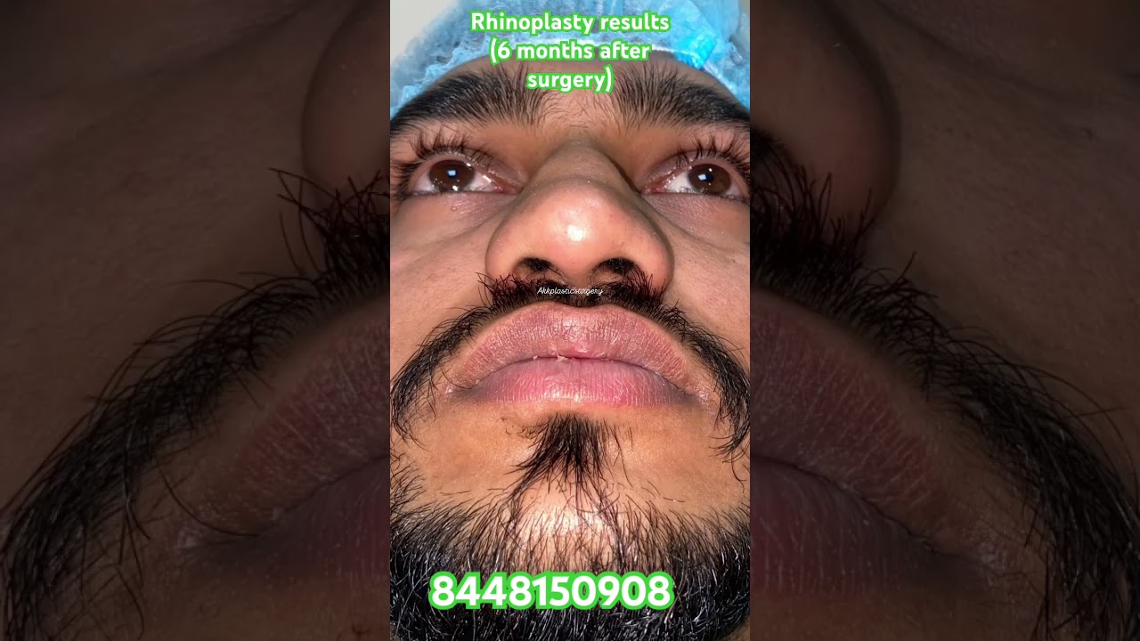 Nose plastic surgery delhi NCR. #rhinoplasty #nosejobs #rhinoplastyspecialist #nose #delhi
