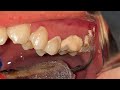 KARANG GIGI PADA GIGI GERAHAM | TARTAR | Dentist | Dokter Gigi Tri Putra