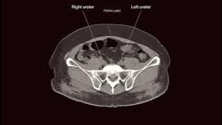 Axial CT KUB outlining the course of the ureters