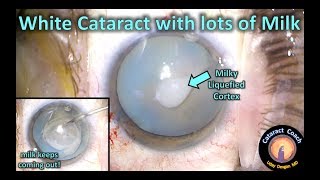 Intumescent White Cataract Surgery with lots of Milk!