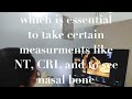 Dr Seema Meena- Fetal Medicine Consultant : Basic question asked during NT scan.
