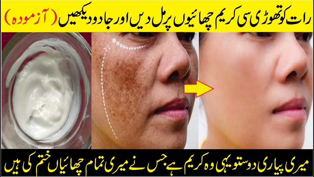I Did Pigmentation Treatment On My Face With Pigmentation Removal Cream: Beauty Tips In Urdu