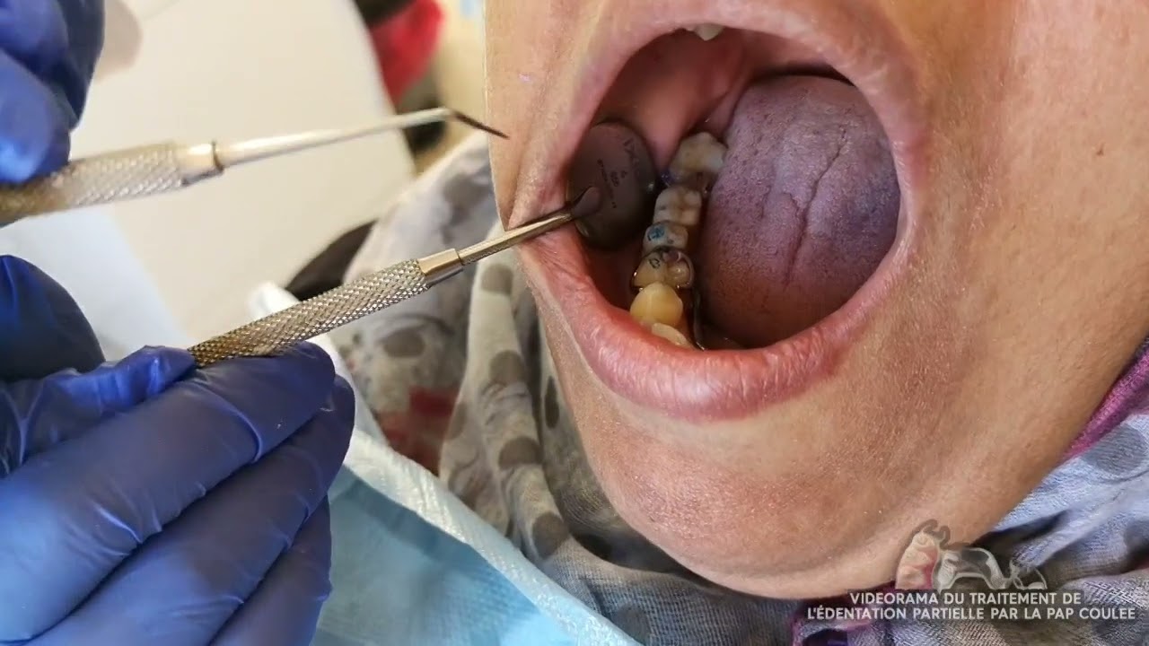 11e vidéo Mise En Bouche des 2 prothèses