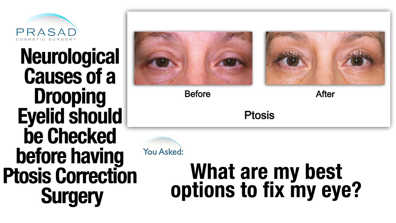 Droopy Eyelid Ptosis Causes Risk Factors And Treatment