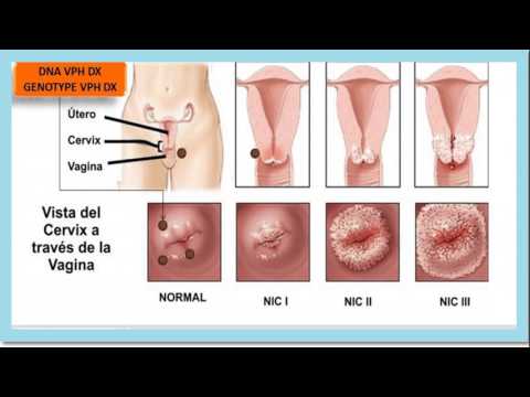 sintomas del papiloma humano en las mujeres