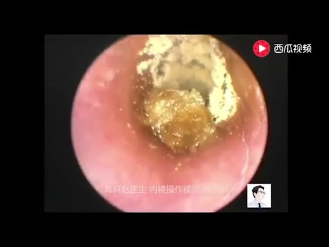 Earwax Removal Extraction, Different colors of the outer ear fungus, 11