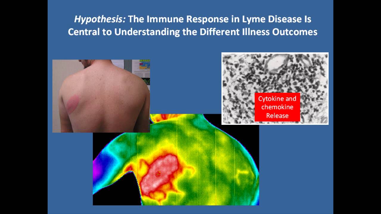 lyme syndrome