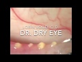 Meibomian gland dysfunction @ Dry Eyes Los Angeles / Dr. Lorin Vogel