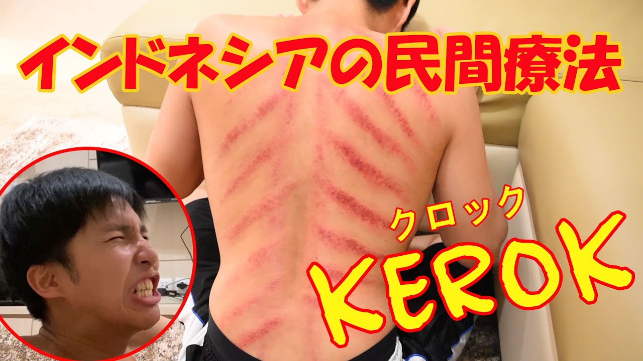 インドネシアの民間療法Kerok（クロック）がすごかった！コインマッサージで風邪が治る！？Orang Jepang Coba Kerok.