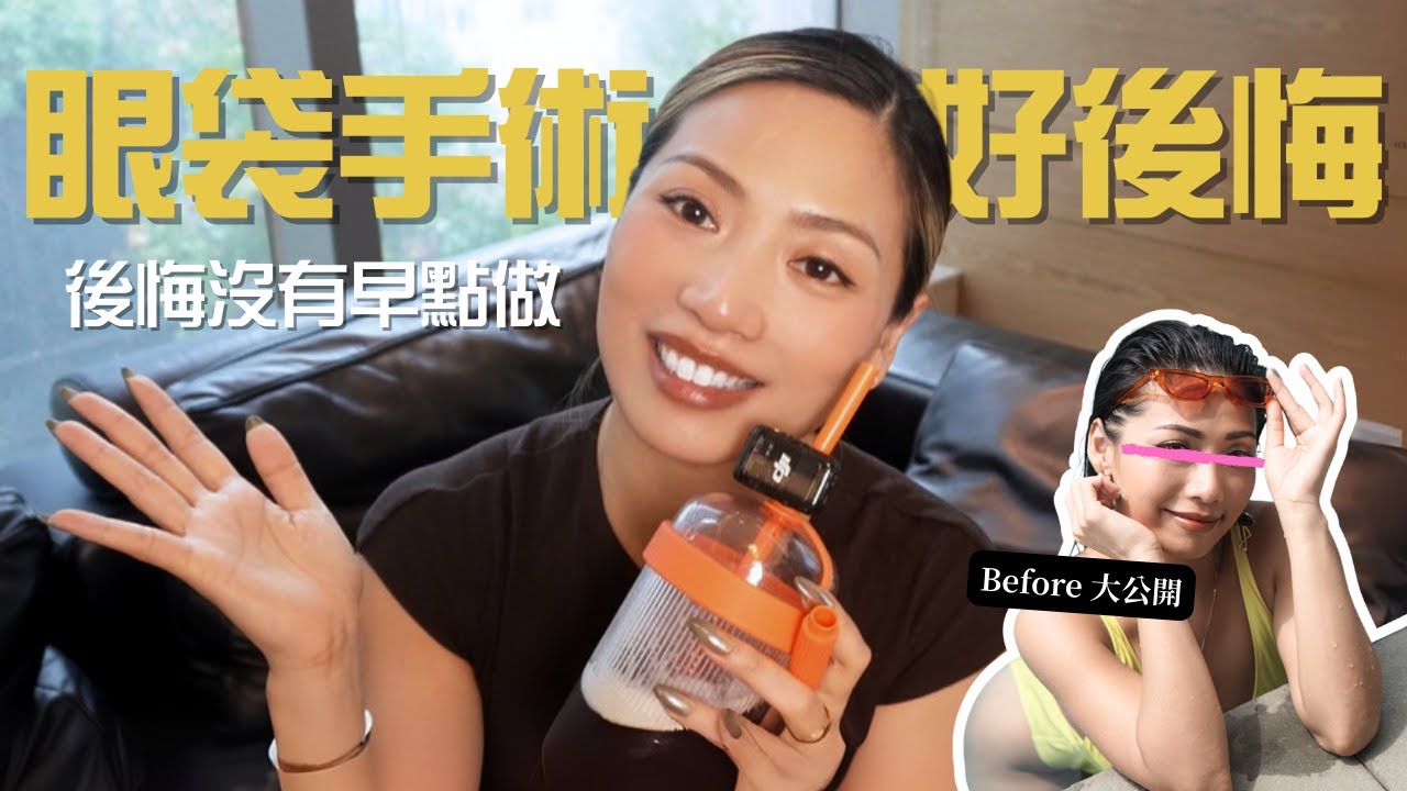 眼袋手術大公開！珍貴康復片段+三年後update！