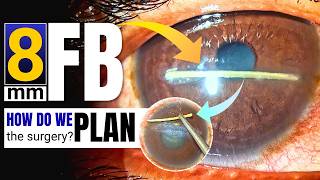 8 mm long deep-seated "Corneal FB" removal strategies: Dr. Deepak Megur