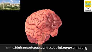 Mild Traumatic Brain Injury - CIMS Hospital