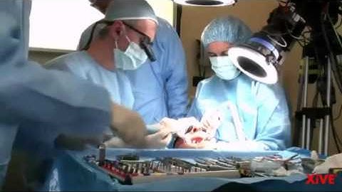 Xive™ Immediate loading in the edentulous mandible | Dentsply Sirona