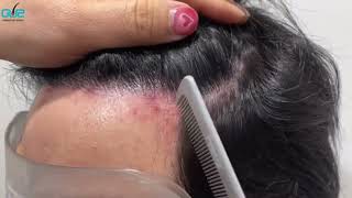 FUE 2700hairs- 10months