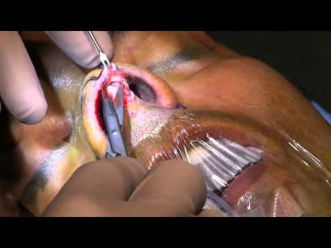 Video thumbnail: Open Approach · Dr. Philip Miller, MD, FACS
