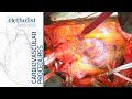 Heart Transplant (Thomas E. MacGillivray, MD, Erik Eddie Suarez, MD, M. Mujeeb Zubair, MD)