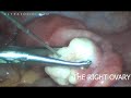 Ovarian rejuvenation. Laparoscopic assisted approach
