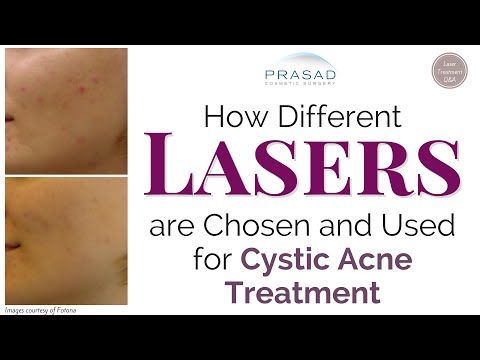 How the Right Laser is Chosen to Treat Cystic Acne , along with Accompanying Treatments