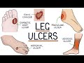 Understanding leg and foot ulcers