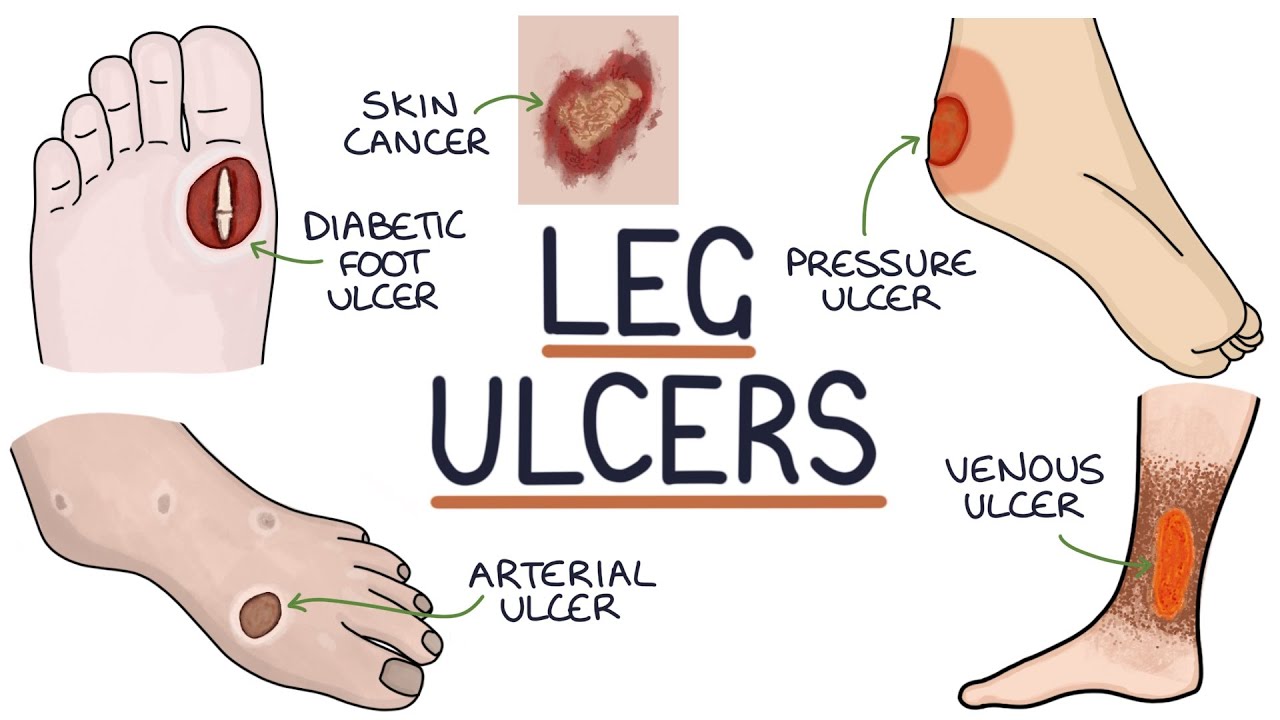 Diabetic Foot Ulcer Causes, Symptoms, Diagnosis, Treatment in Lubbock TX –  Southwest Regional Wound Care Center