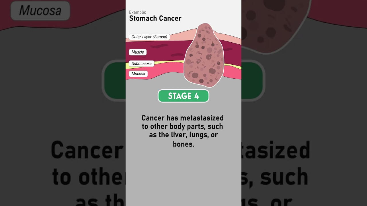 Cancer Staging - Part 2