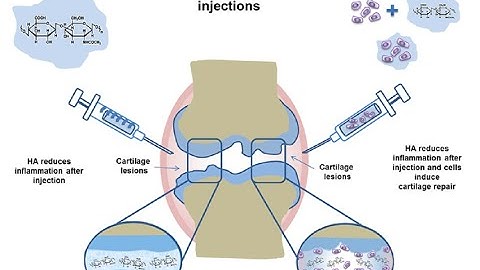 Intra-articular Route of Drug Administration ; injecting medications directly into a joint space