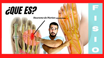 ¿Qué es el síndrome del dedo de Morton?