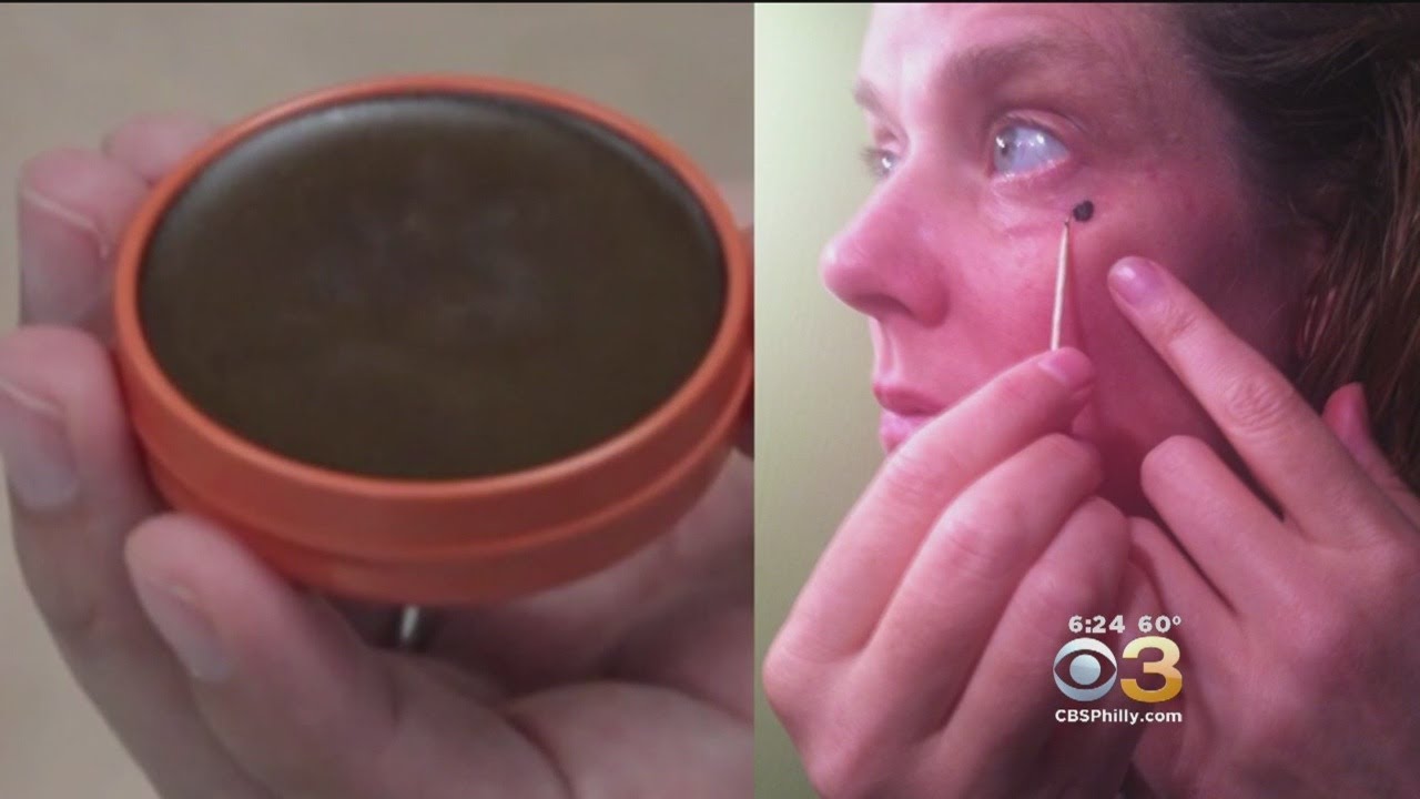 Doctors Warn Against Unproven Skin Treatment Called Black Salve