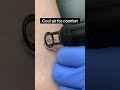 Laser tattoo removal