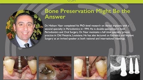 Osseodensification: Bone Preservation Might Be the Answer - Dr. Hisham Nasr