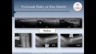 Kemik Fraktürlerinde Ultrasonografi