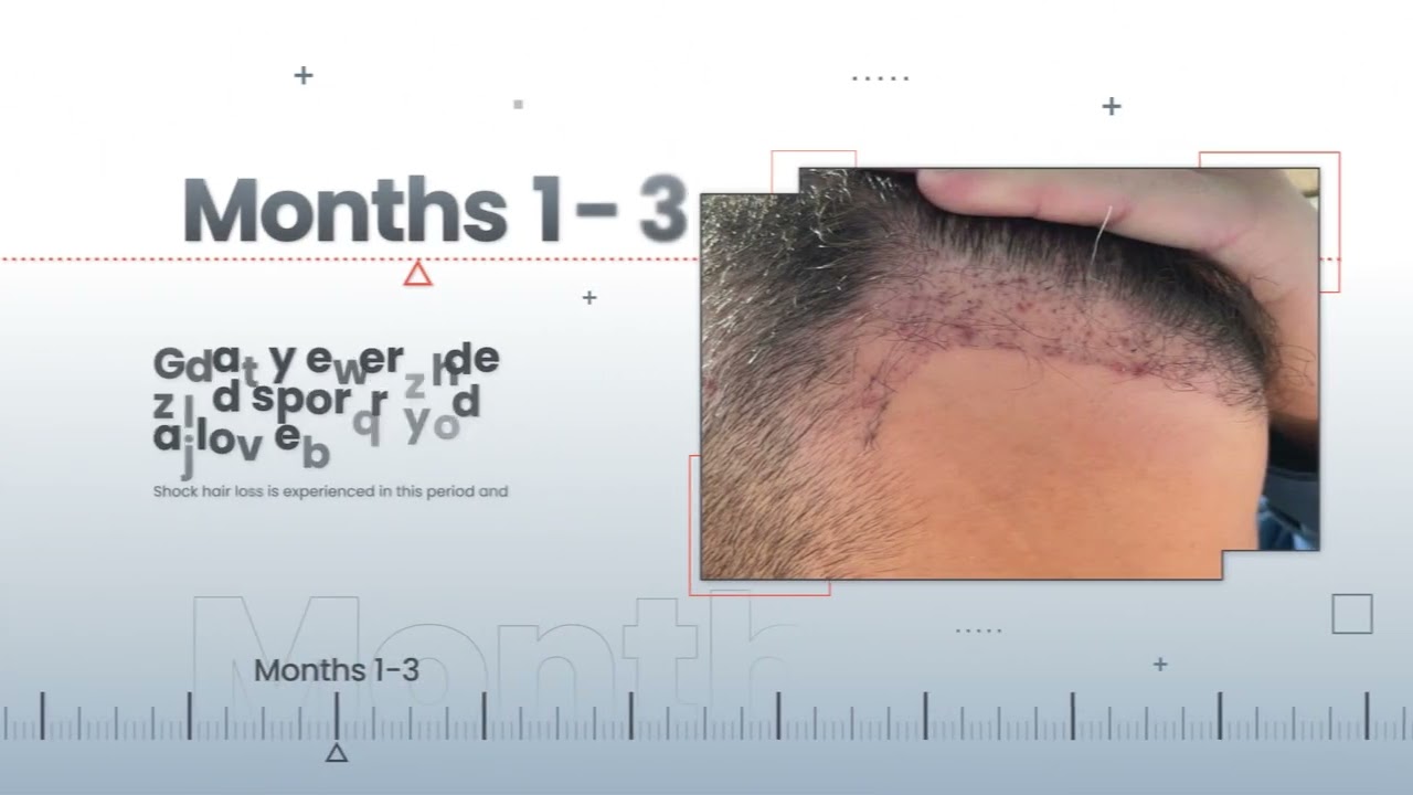 After Hair Transplant Timeline / Process