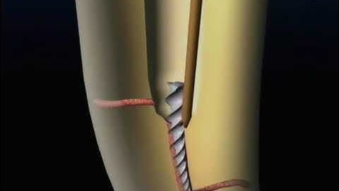 How to remove a separated instrument using ultrasonic | Endodontics | Rotary Files | pinkblue