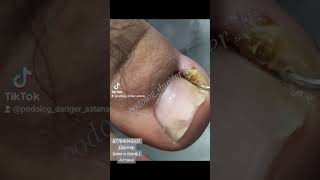 вовремя придти- 90% успеха🤗🤲😘иначе прямой путь к хирургі, а затем , ВСЁ РАВНО ,к нам ..