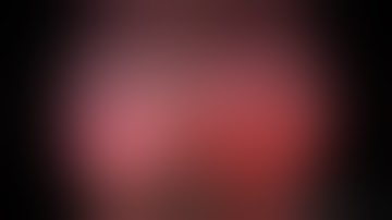 Subxiphoid vats right lower lobectomy for pulmonary sequestration