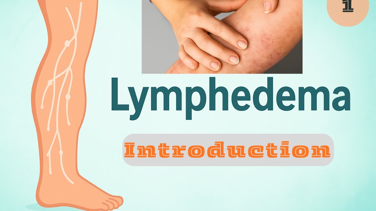 1. Introduction to Lymphedema | كل اللي محتاج تعرفه عن الـ Lymphedema