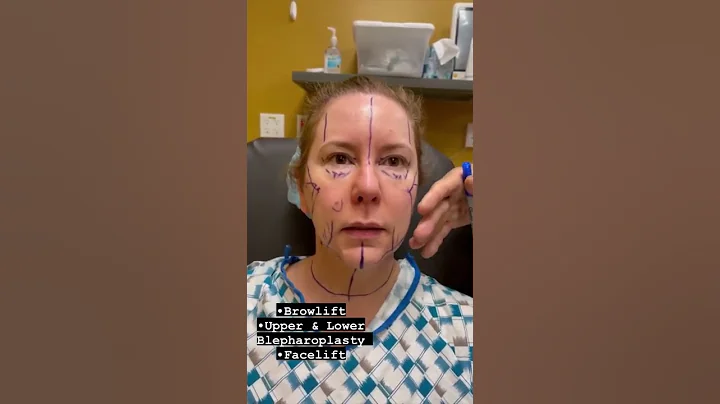 Marking face for Brow lift , Blepharoplasty, & Facelift 🖊