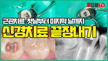 [난생처음,치과진료]치과치료 중 신경치료 전과정 이해하기