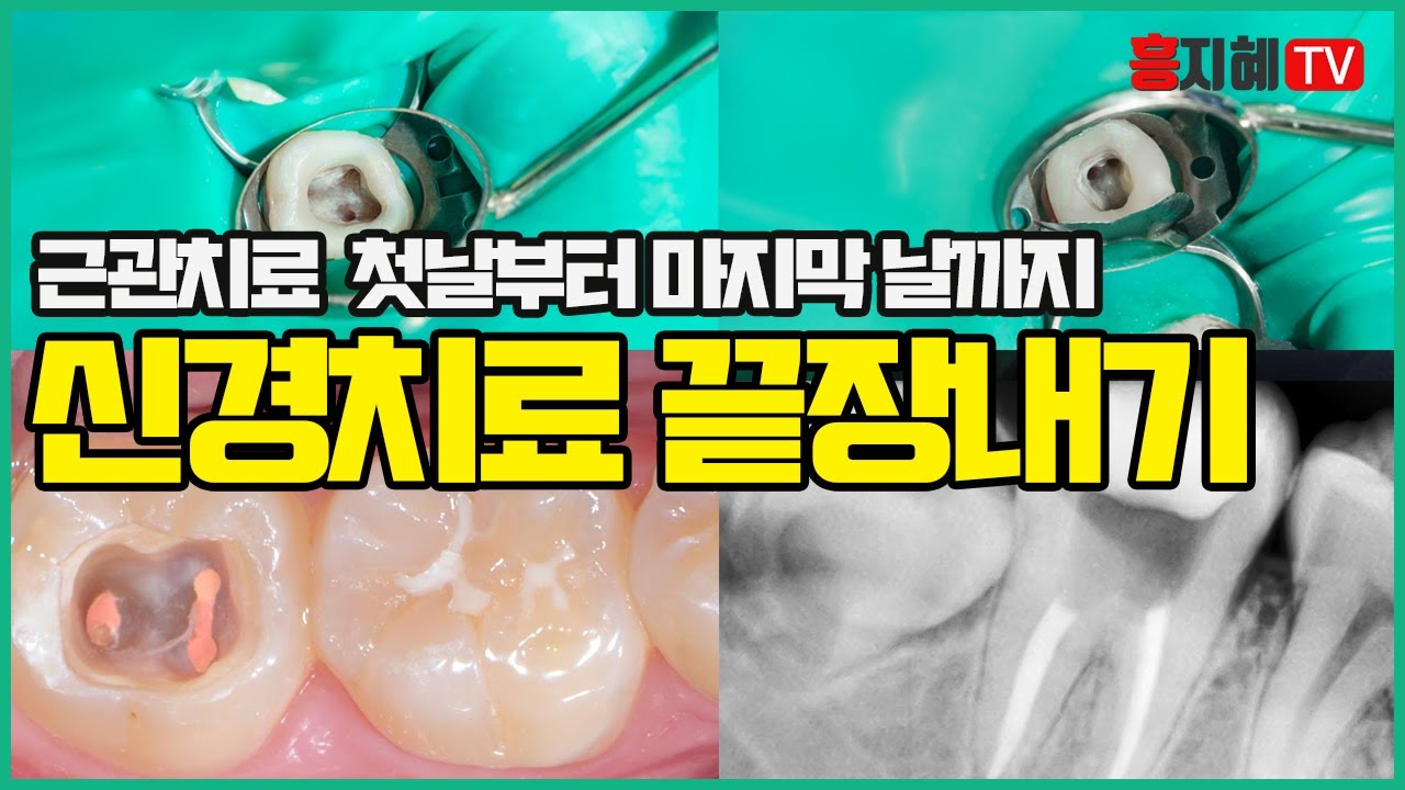 [난생처음,치과진료]치과치료 중 신경치료 전과정 이해하기